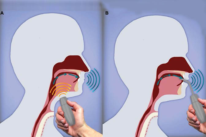 Artificial Larynx